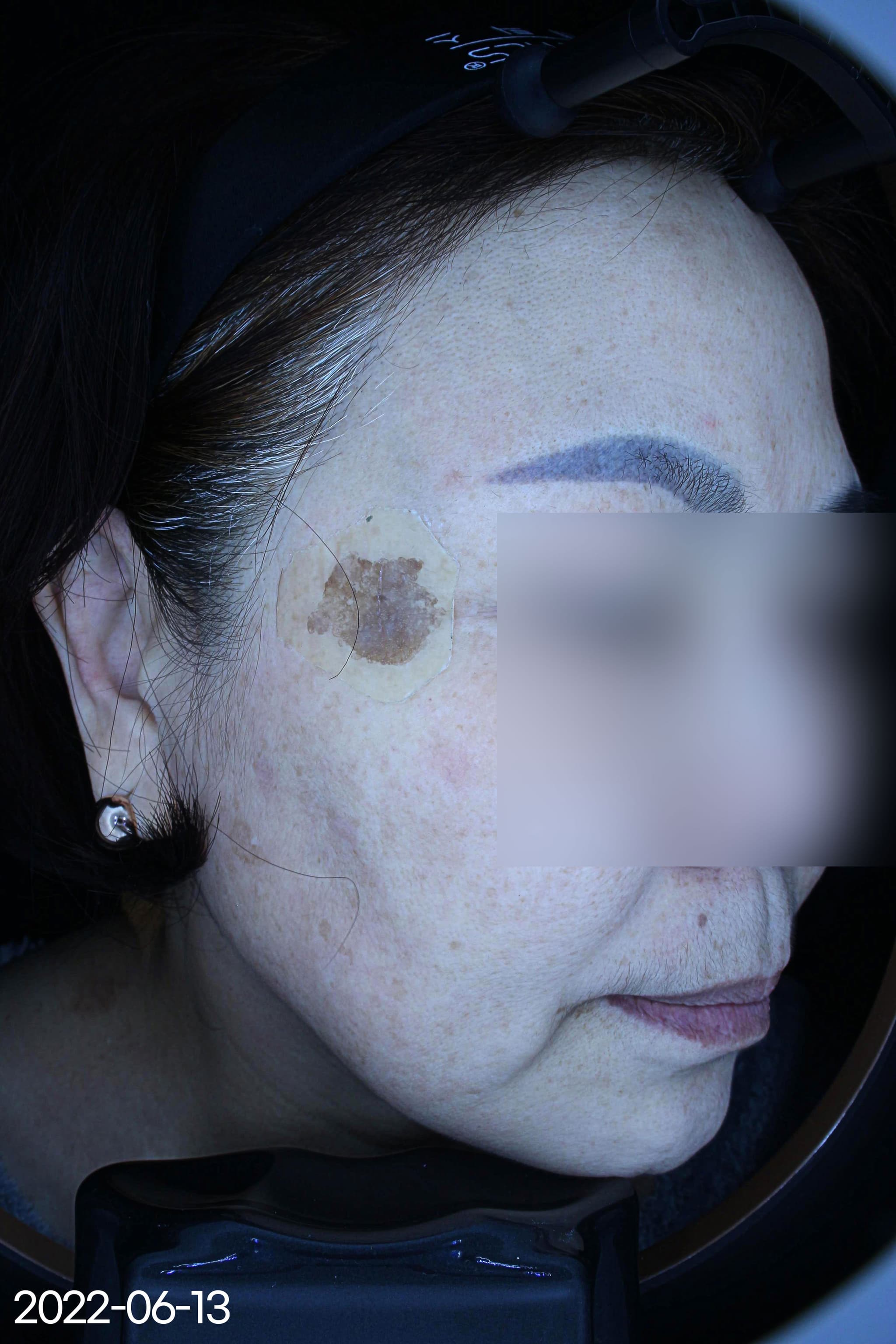 흑자 제거 사례 1 Before