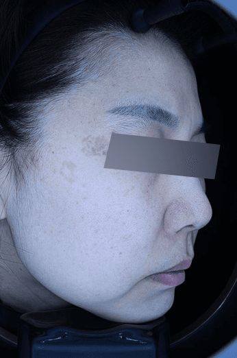 흑자 제거 사례 2 Before