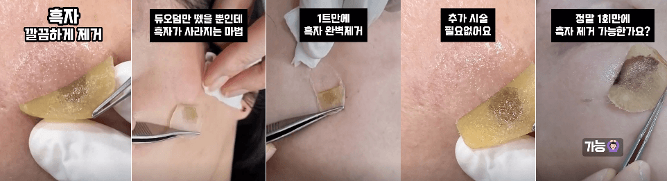 흑자 한번에 제거