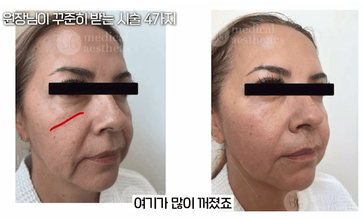 세르프 리프팅, 피부엄마가 한 시술, 하지 않은 시술